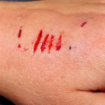 dog bite precautions