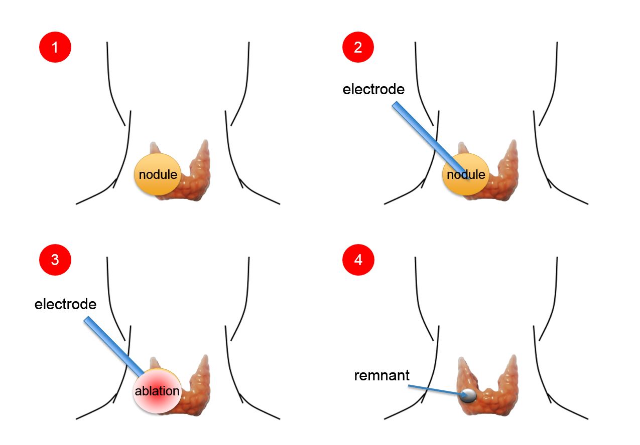 thyroid disorders