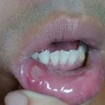 mouth ulcer
