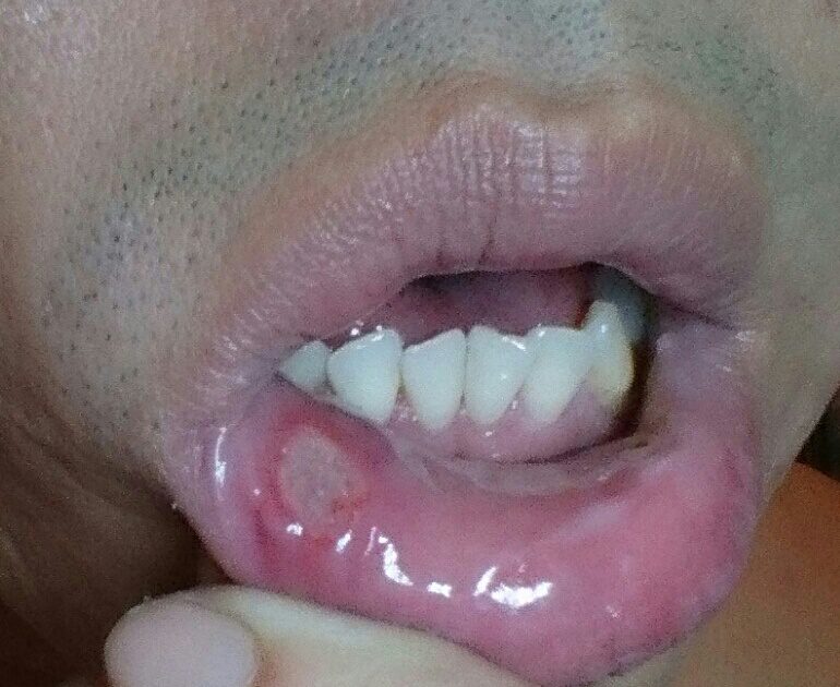 mouth ulcer