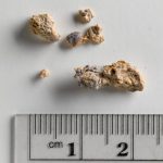 Diet for Kidney Stones