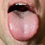 Spots on Tongue