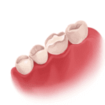 Root Canal Treatment - Types, Procedure and Durability