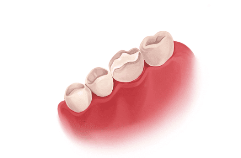Root Canal Treatment - Types, Procedure and Durability