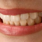 Dental veeners types and their Durability and Cost