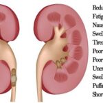 Kidney Failure: Functions, Causes And Symptoms