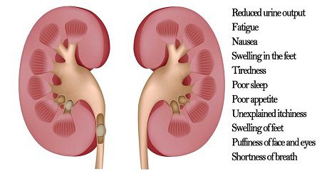 Kidney Failure: Functions, Causes And Symptoms