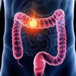 What Are The Symptoms Of Colorectal Cancer?