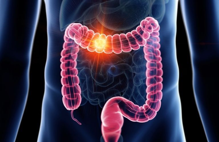 What Are The Symptoms Of Colorectal Cancer?