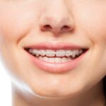 Which Is Better Ceramic Braces or Metal Braces