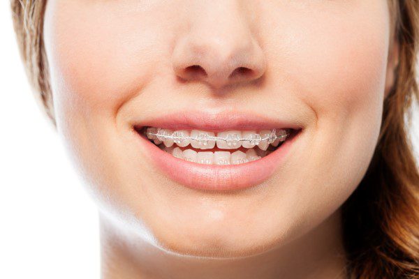 Which Is Better Ceramic Braces or Metal Braces
