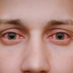 Causes, Symptoms And Precautions Of Conjunctivitis