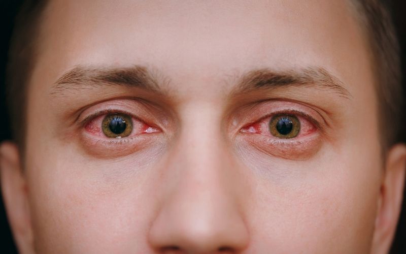 Causes, Symptoms And Precautions Of Conjunctivitis