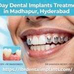 Dental Implants treatment in 7 Days in Madhapur Hyderabad